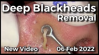 Deep Blackhead Removal by @drkasanas