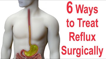 6 Ways to Surgically Treat Reflux (Nissen, Toupet, Dor, LINX, EsophyX, Stretta)