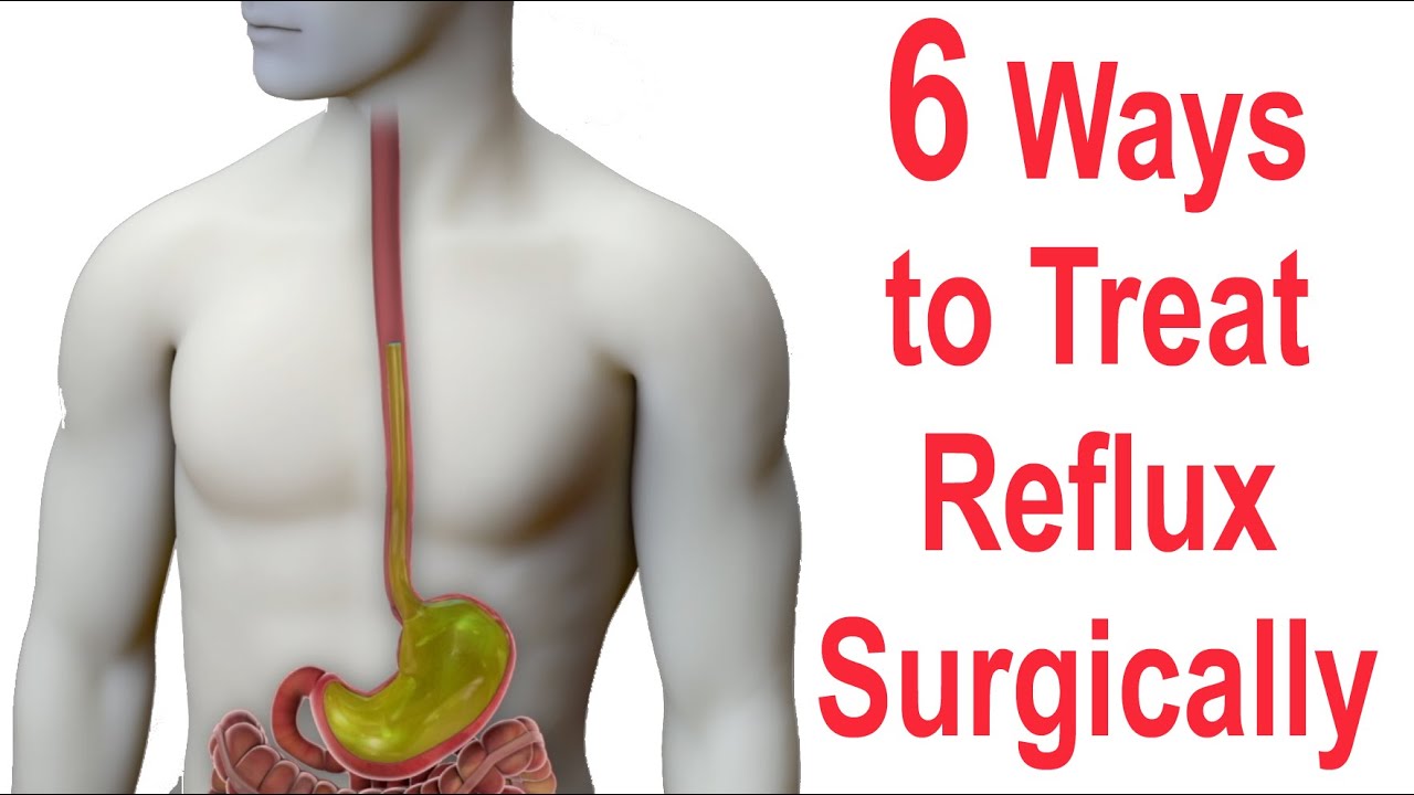 Download 6 Ways to Surgically Treat Reflux (Nissen, Toupet, Dor, LINX, EsophyX, Stretta)