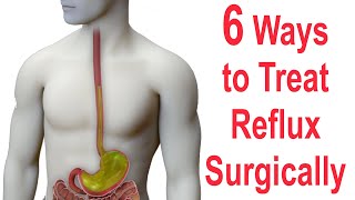 6 Ways to Surgically Treat Reflux (Nissen, Toupet, Dor, LINX, EsophyX, Stretta)