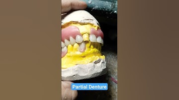 Acrylic Removable Partial Denture Teeth Arrangement By Haider #dentalartbyhaider #rpd #dentures