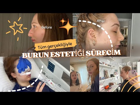 Tüm Gerçekliğiyle Burun Estetiği Sürecim | My Realistic Rhinoplasty Process