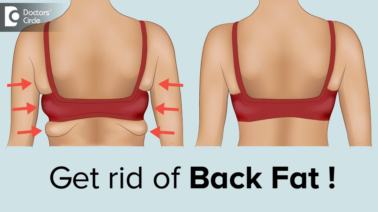 LADIES.Worried About Bra Bulge & Back Fat?, Procedure Explained- Dr.  Srikanth V