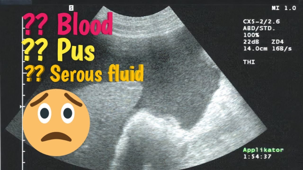 How To Differentiate Between Blood Pus And Serous Fluid By Ultrasound how-to-differentiate-between-blood-pus-and-serous-fluid-by-ultrasound