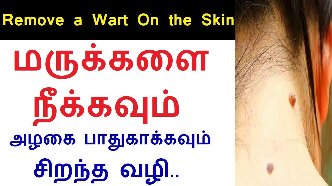 common-wart-removal-tips-treatments-home-remedies-in-tamil-rahul