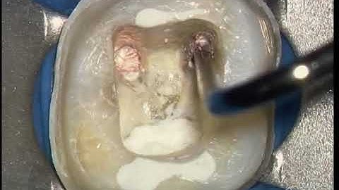 Continuous Wave & Hybrid - Step-by-Step Sequence: Advanced Endodontics Dr. Cliff Ruddle