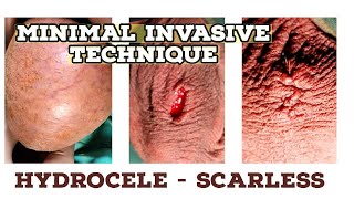 MINIMAL INVASIVE APPROACH - HYDROCELE SURGERY - SCARLESS & COSMETIC TECHNIQUE