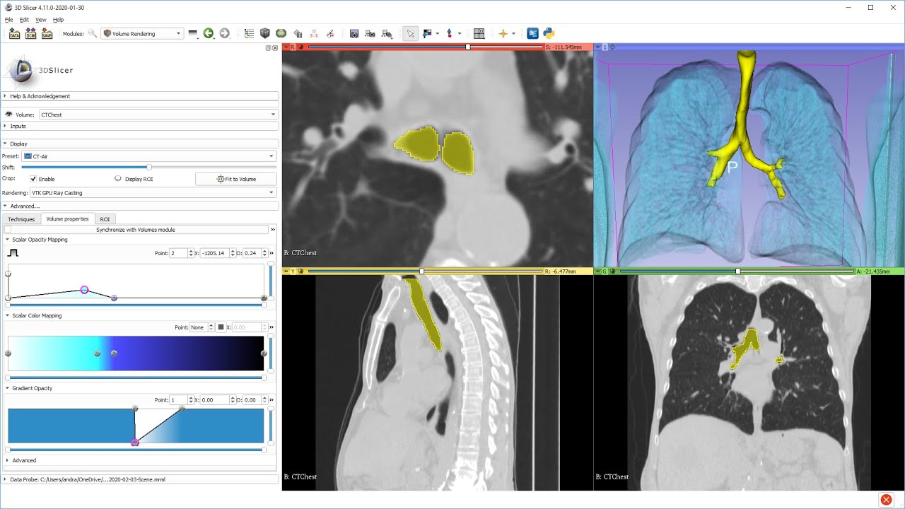 Airway Segmentation From Ct In 1 Minute Using 3d Slicer Youtube