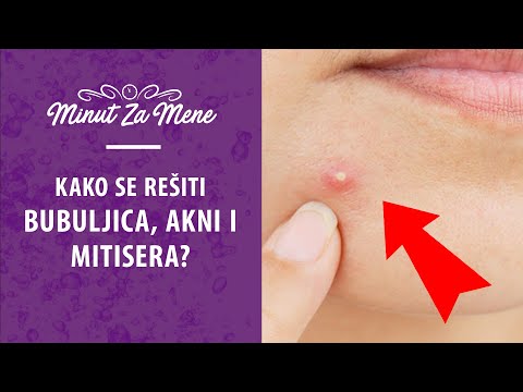 Kako se rešiti bubuljica, akni i mitisera? | Minut za Mene