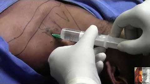 Dual brachial block:Devendra