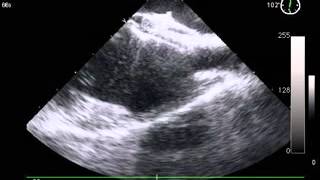 Ultrasept Pfo Echo Post Release