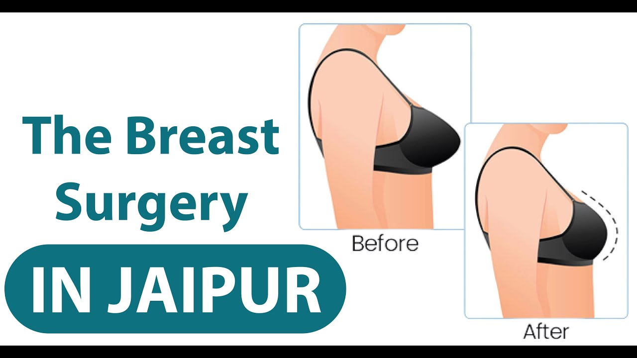 Breast Size Kam Kaise Kare Breast Reduction Surgery How To Reduce breast-size-kam-kaise-kare-breast-reduction-surgery-how-to-reduce