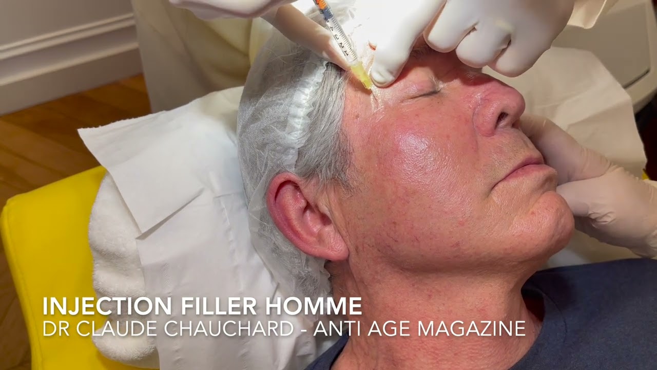 Corrections des rides pour les hommes avec les fillers par le Dr Claude Chauchard