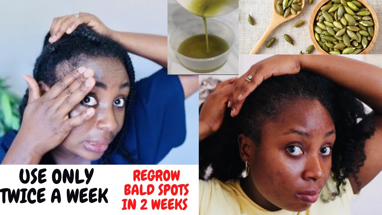 Magic Hair Growth Oil For Bald Spots, Thinner Hair And Alopecia/ Use 2x