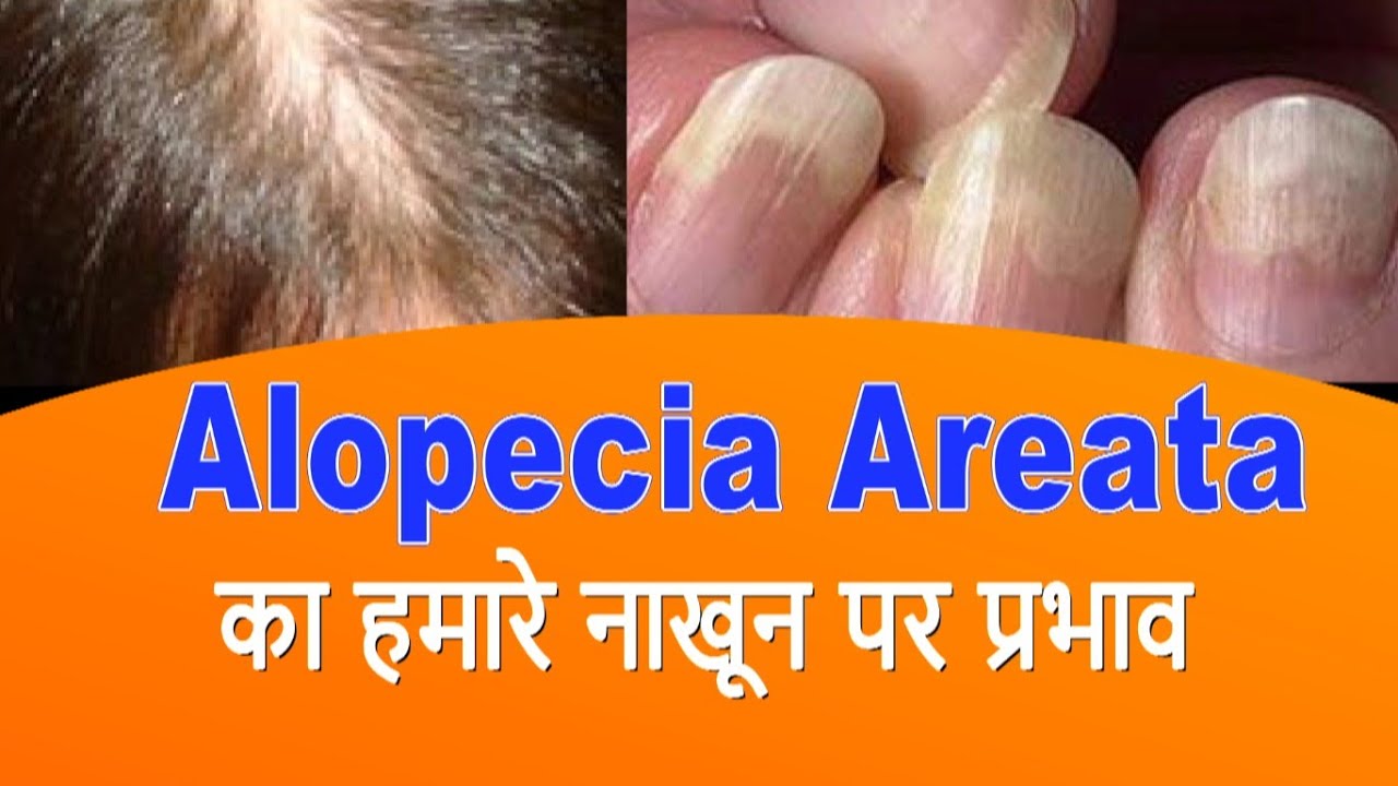 Alopecia: What It Is, Causes, Signs, and Treatment | Osmosis