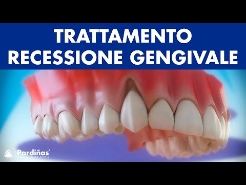 Video: Gengive - Trattamento Delle Gengive Sanguinanti Con Rimedi Popolari