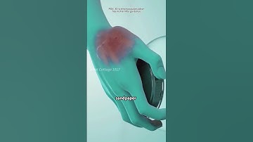 How A Tendon Can Replace Trapezium Bone In Thumb Arthritis? (3D Animation)