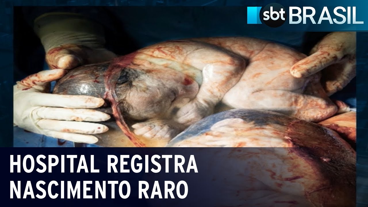 Hospital no Rio de Janeiro registra nascimento raro de gêmeos | SBT Brasil (15/11/21)