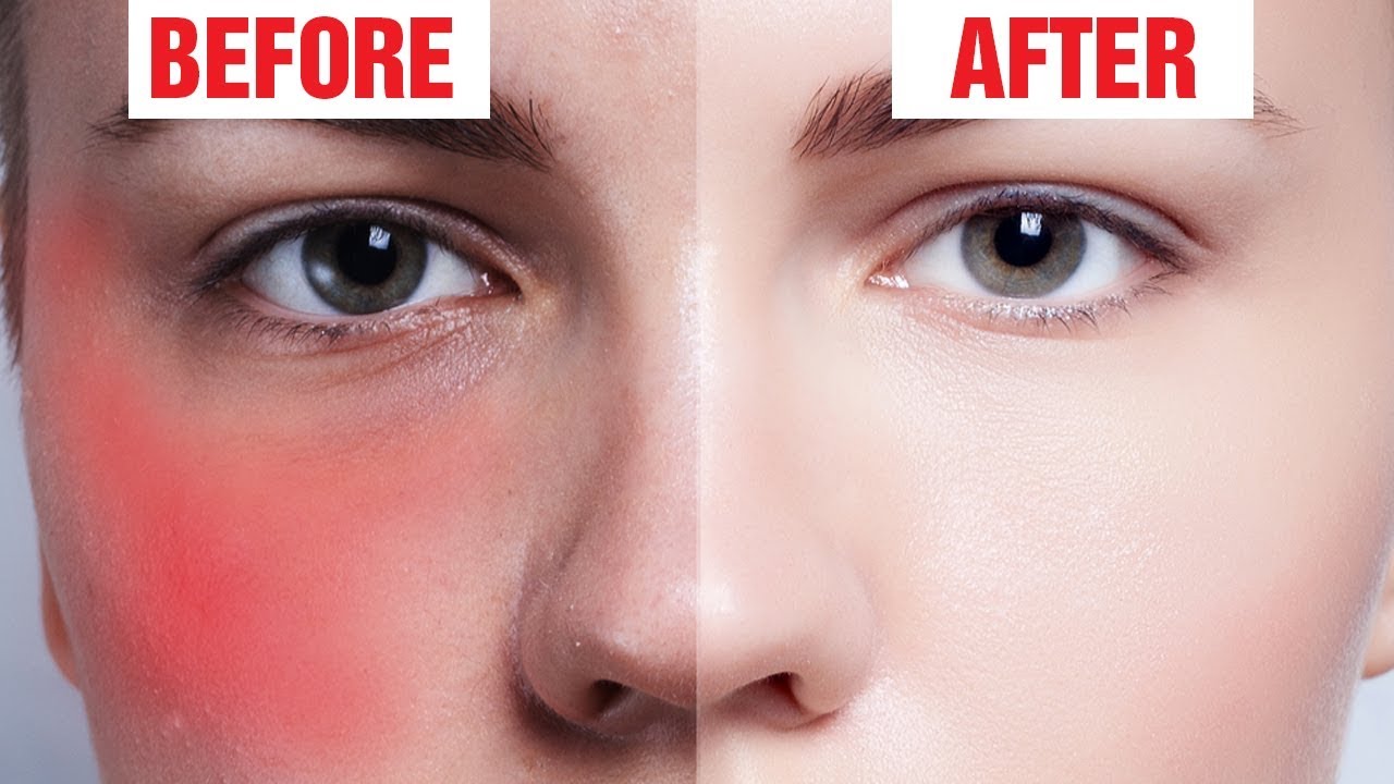 7 Natural Ways To Get Rid Of Redness On Face Youtube