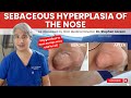Dermatologist explains how to treat nose bumps due to sebaceous hyperplasia