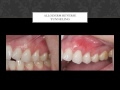 Alloderm Reverse Tunneling, &quot;ART&quot; Gum Grafting Technique, Before &amp; After