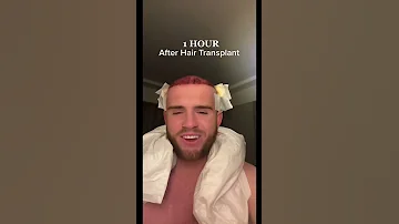 Hair Transplant Results !