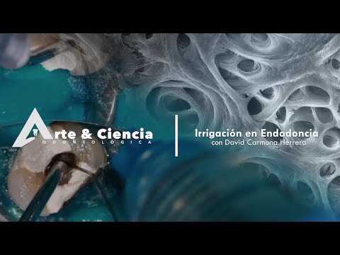 Video: ¿Durante el tratamiento de endodoncia se irrigan los conductos pulpares?