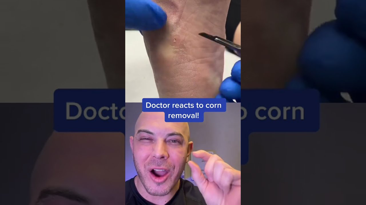 Doctor Reacts To Corn Removal On The Foot Itscorn Dermreacts