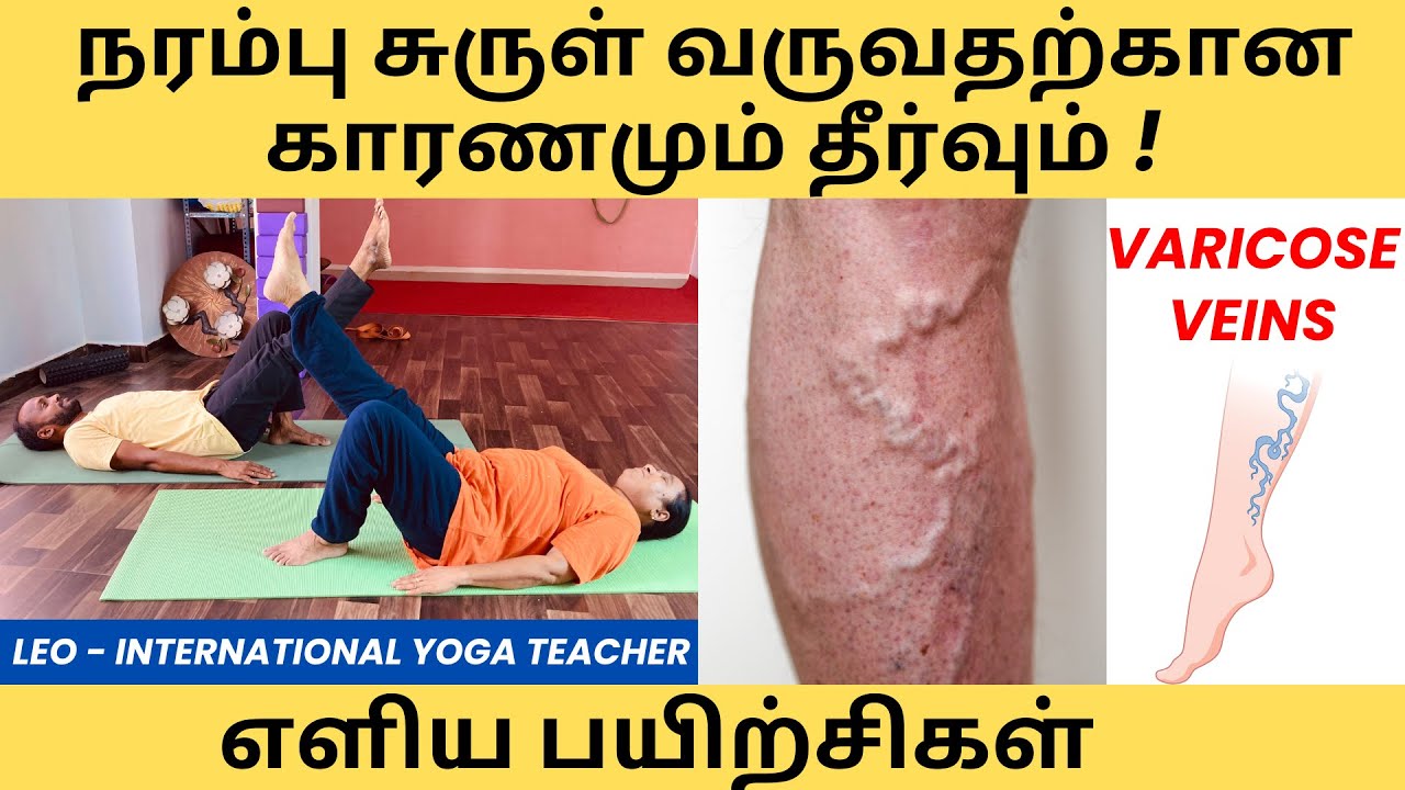 Varicose Vein Natural Way In Tamil varicose-vein-natural-way-in-tamil