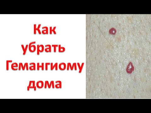 Видео: Как убрать пиогенную гранулему в домашних условиях?