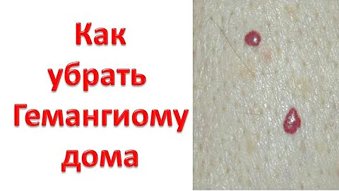 Как убрать гемангиому дома? Домашний электрокоагулятор.