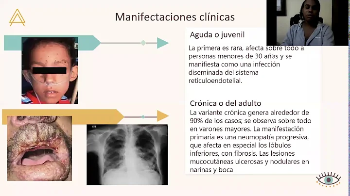 ENFERMEDADES MICTICAS DEL PULMN/ PNEUMOTALOGIA/ SE...