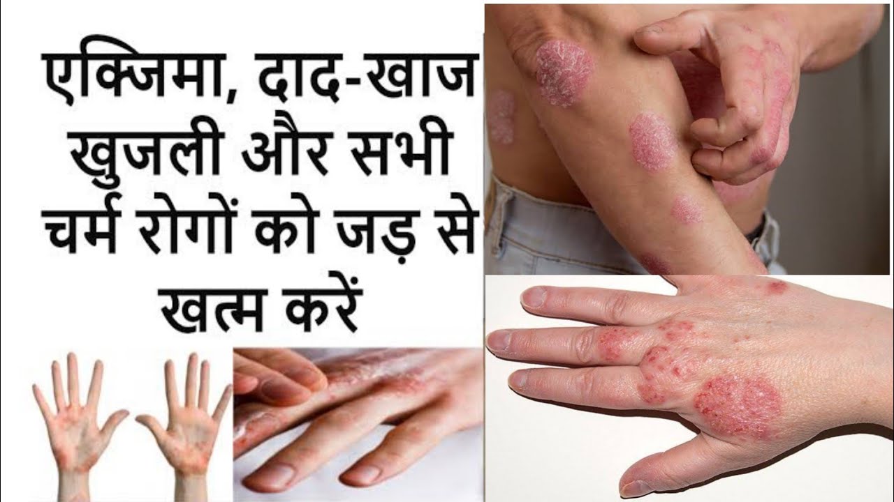 Eczema Treatment In Hindi एक्ज़ेमा का इलाज Skin Allergy, Dermatitis