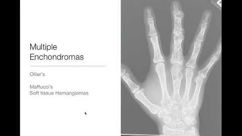 Bone Tumors - Polyostotic tumors Part 1