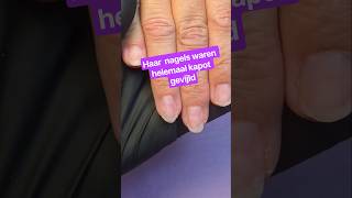 Te dun gevijlde nagels
