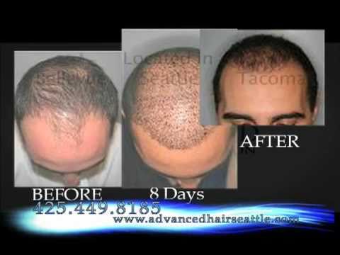 What Is The Cost Of Neografting The Hair Line | fue hair transplant advanced fue in seattle 425 449 What Is The Cost Of Neografting The Hair Line | fue hair transplant advanced fue in seattle 425 449
