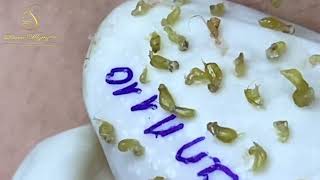 Loan Nguyen Acne Treatment speacal 6