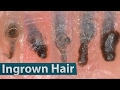 Ingrown Hair Removal Close up 200X | 埋没毛を除去