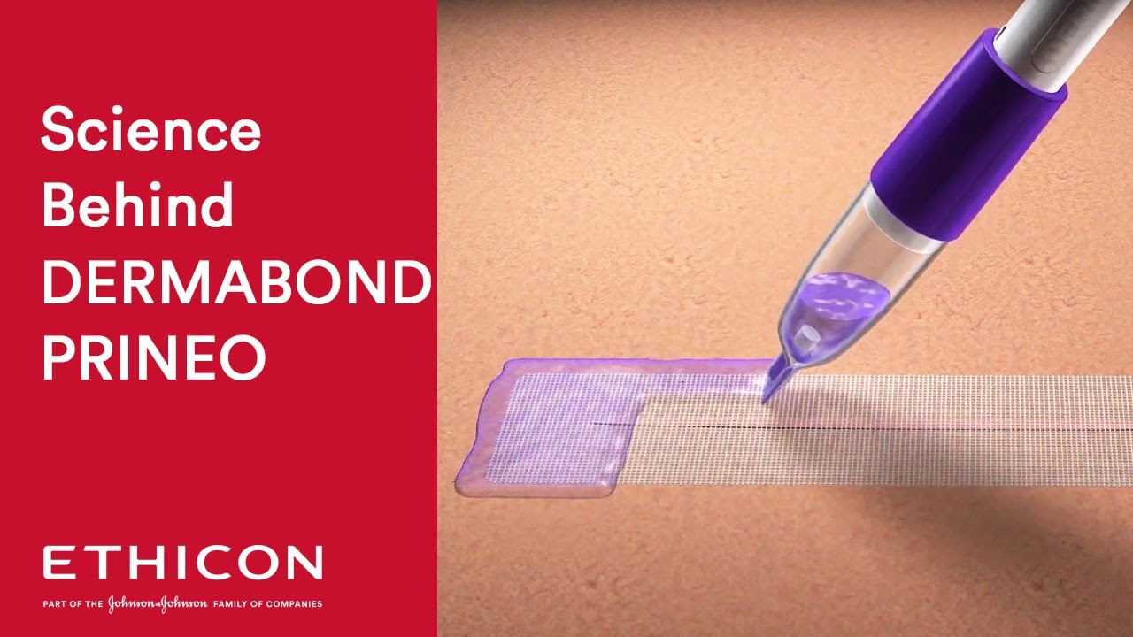 Science Behind Stronger Closure Using DERMABOND PRINEO Skin Closure System