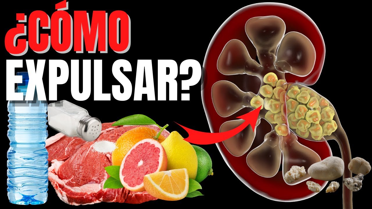 🔴¡ATENCIÓN! ¿CÓMO EXPULSAR LAS PIEDRAS🪨🪨🪨 EN EL RIÑON? - HOW TO ...
