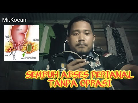 Alhamdullilah Sembuh Abses Perianal (Fistula ani) tanpa operasi