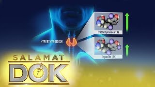 Hyperthyroidism | Salamat Dok