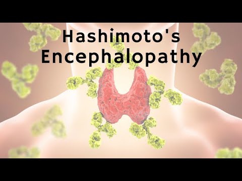 Thyroid Disease as a Cause of Psychosis: Hashimoto&rsquo;s Encephalopathy