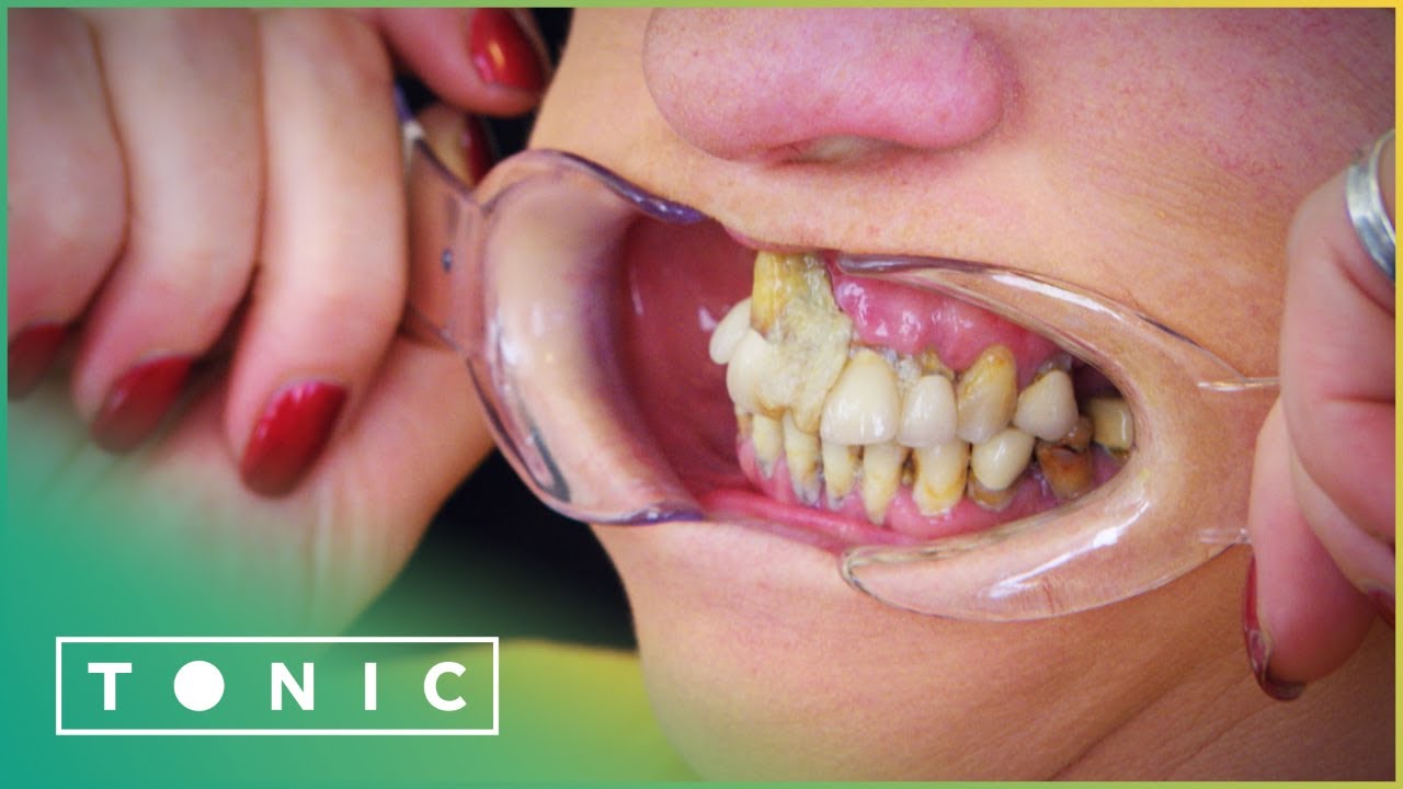 Woman Glues Her Teeth Back In Place To Avoid The Dentist | The Truth About Your Teeth | Tonic