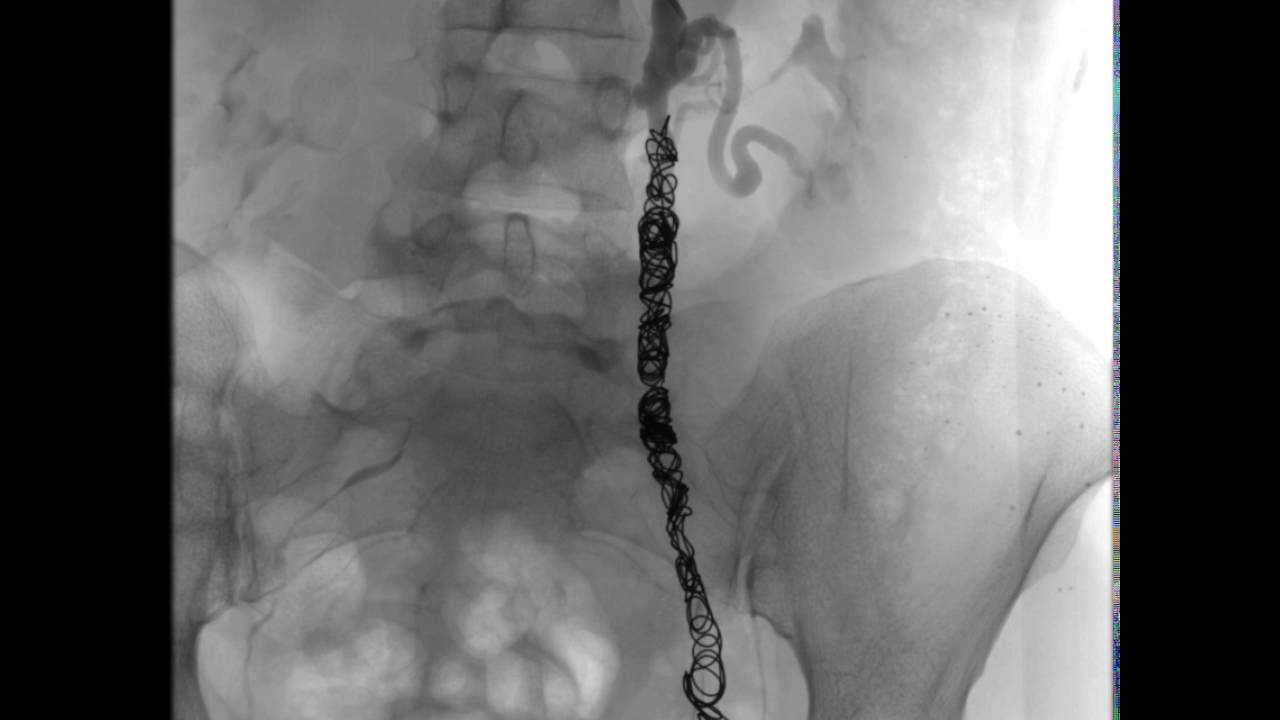 varicoza precursor varicoza i ureplasma