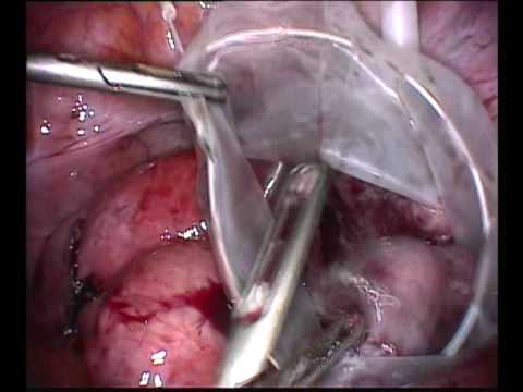 infection du au stérilet infection du au stérilet
