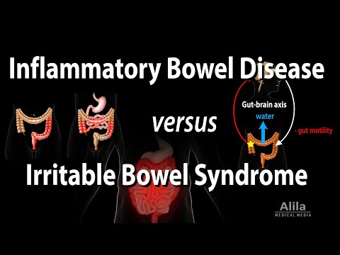 Video: Perbedaan Antara IBD Dan IBS