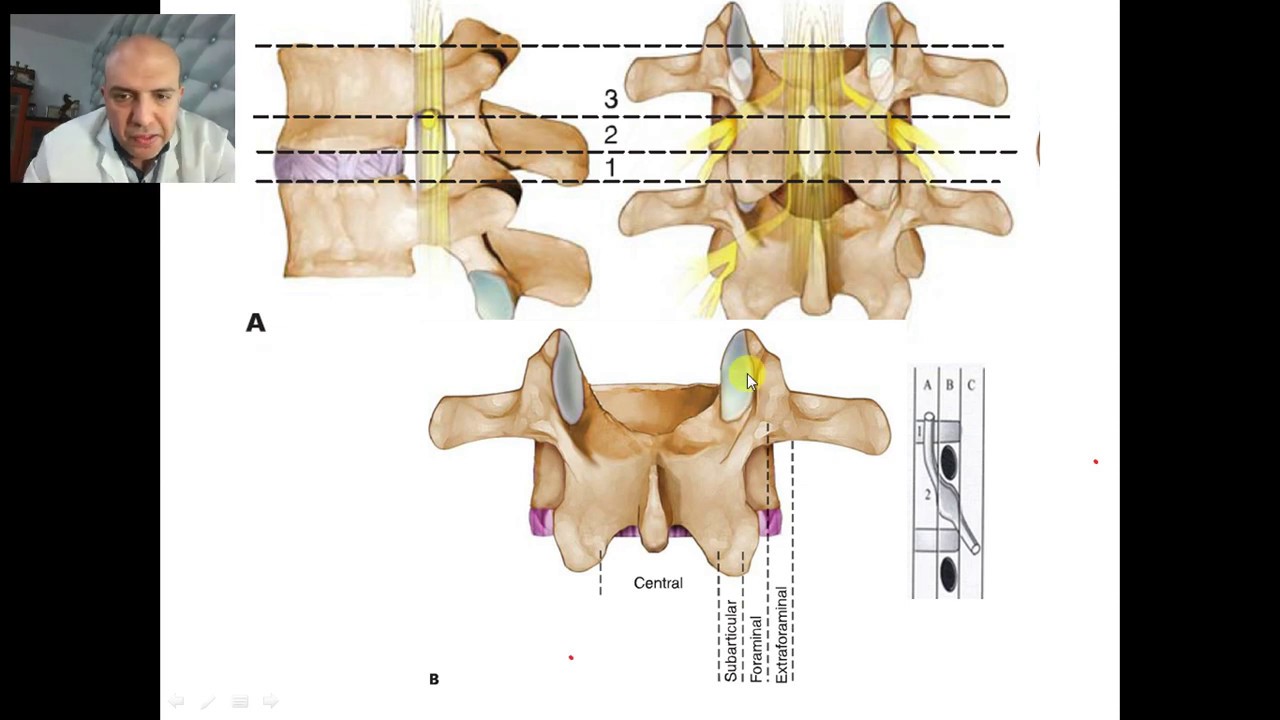 degenerative lumbar disc herniation YouTube