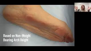 Different Types of Flat Feet & Impact on Function