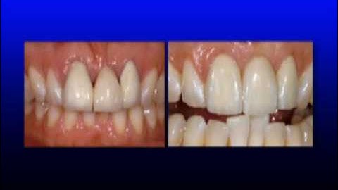 Ovate Pontics- Soft Tissue Restorative Considerations